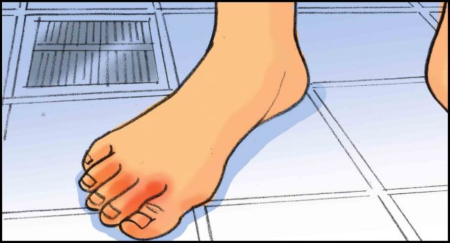 Color storyboard frame for advertising agency, foot with toe redness.